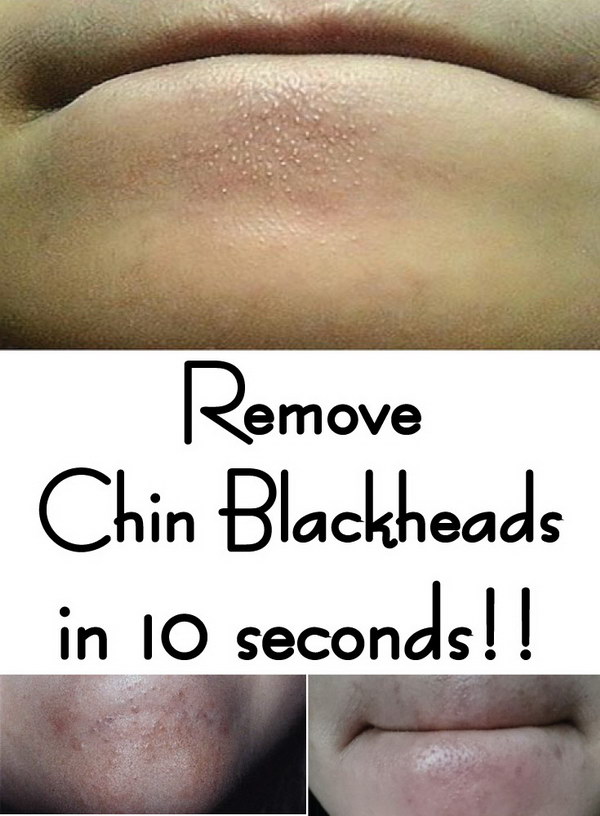 Remove Chin Blackheads in 10 seconds. 