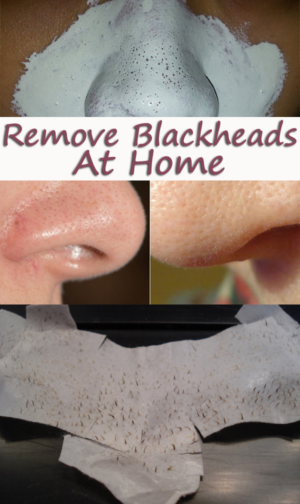 Homemade Blackheads Remover Tutorials And Ideas Hative