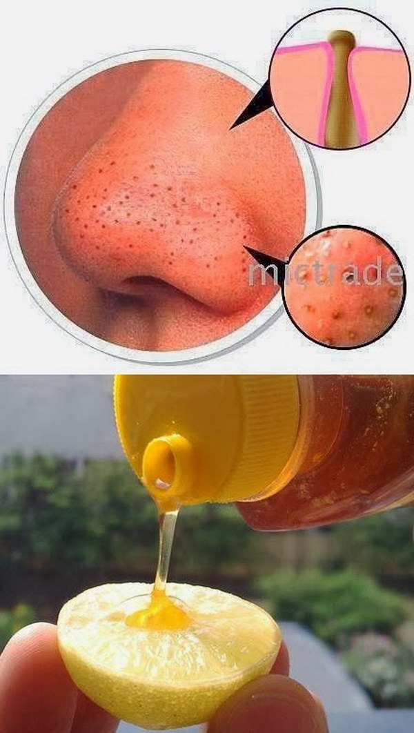 Remove Blackheads with Lemon and Honey. 