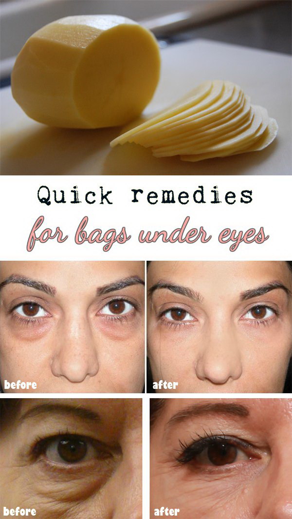 download sudden dark circles under eyes